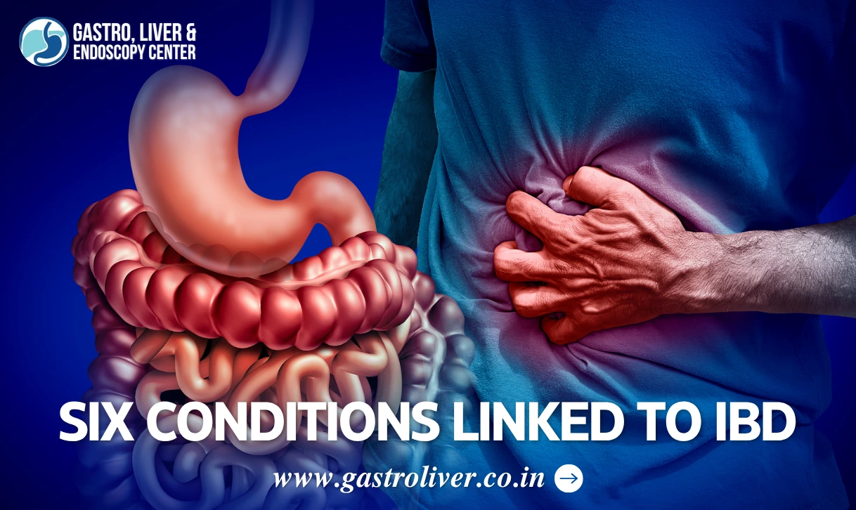 Six Conditions Linked to IBD
