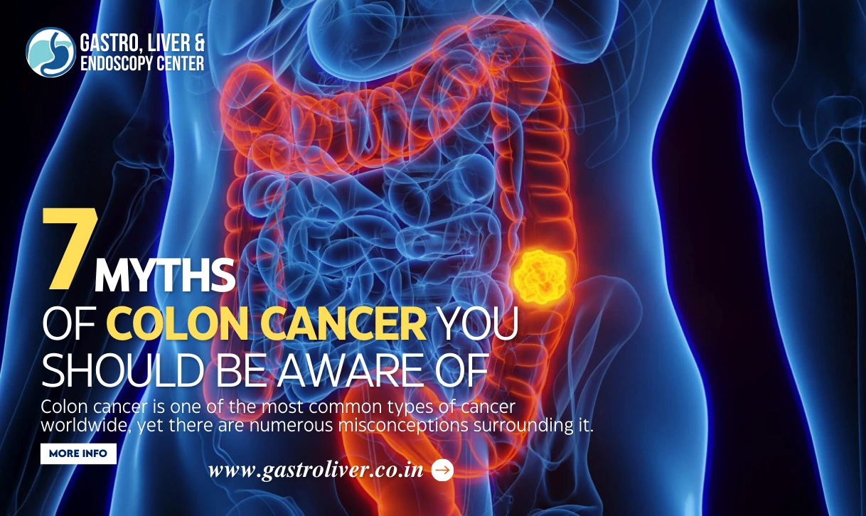 7 Myths of Colon Cancer You Should Be Aware Of