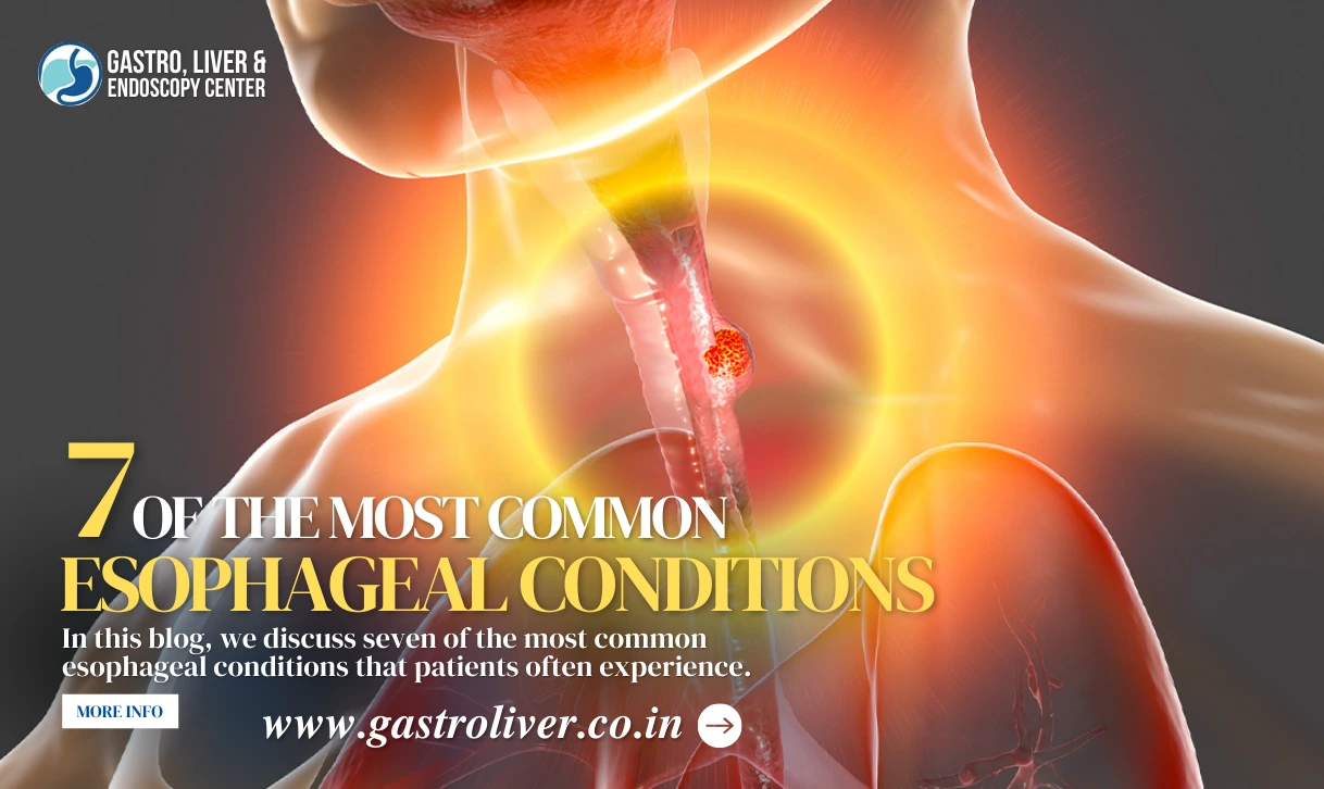 7 of the Most Common Esophageal Conditions