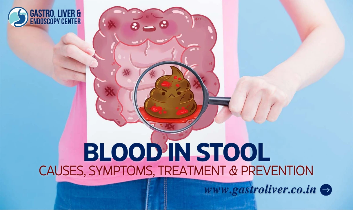 Blood in Stool – Causes, Symptoms, Treatment & Prevention