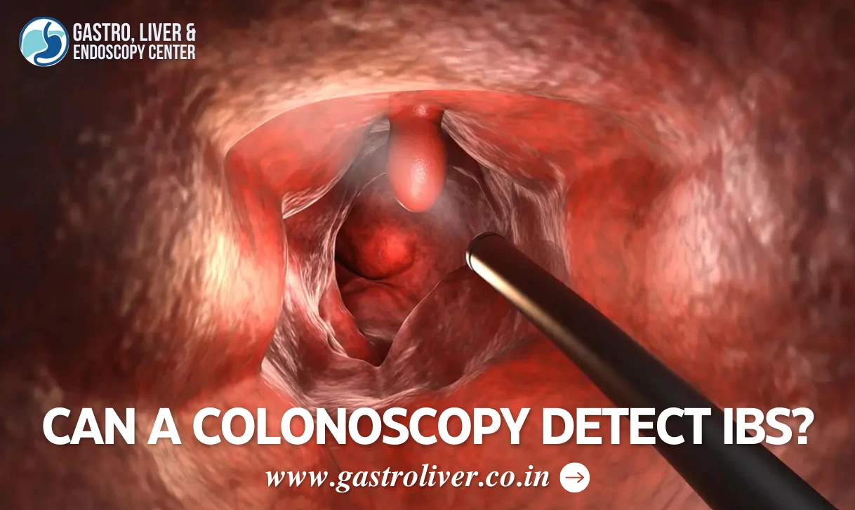 Can a Colonoscopy Detect IBS?