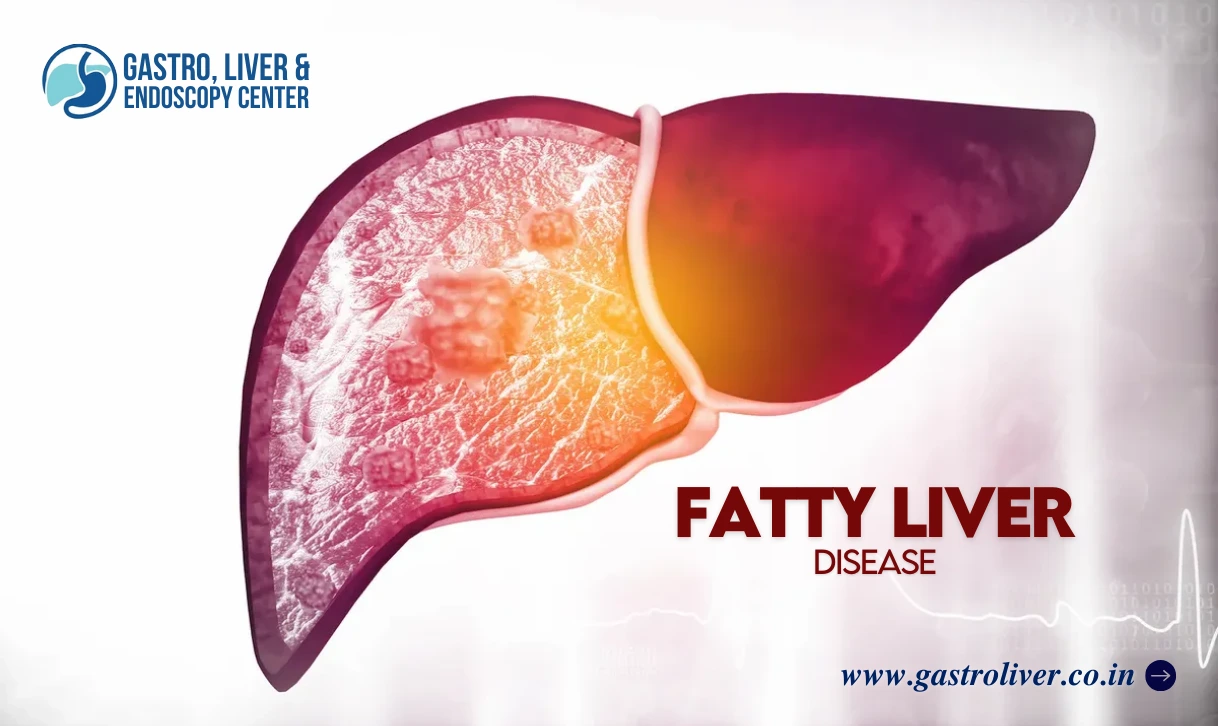 What Are the Common Signs of Fatty Liver Disease?