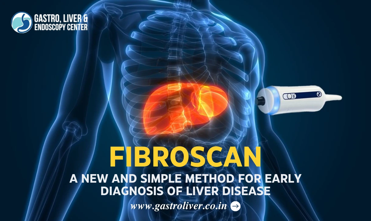 Fibroscan: A New and Simple Method for Early Diagnosis of Liver Disease