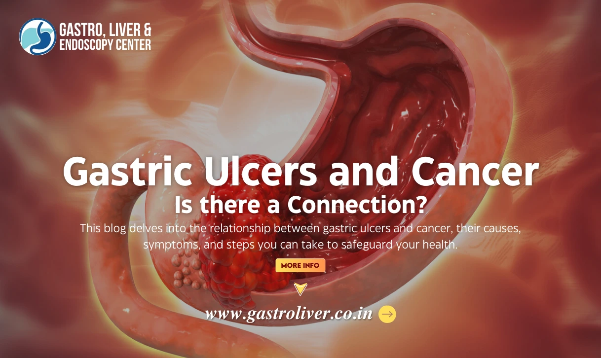 Gastric Ulcers and Cancer: Is There a Connection?