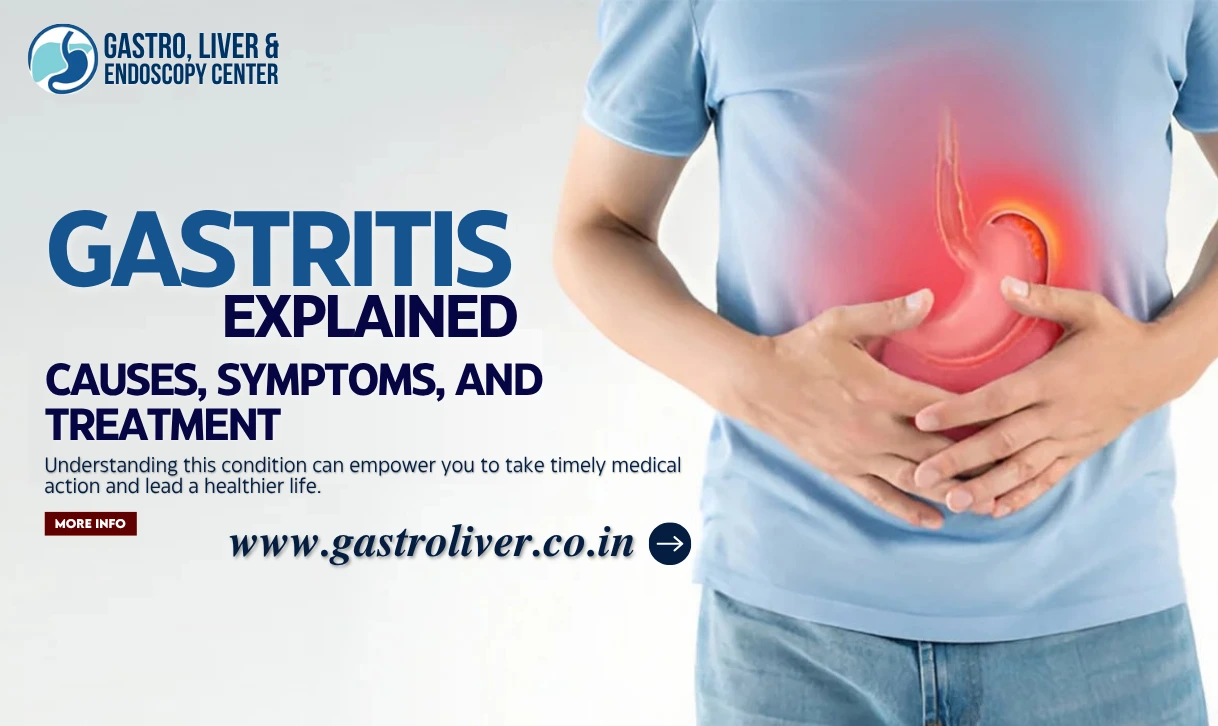 Gastritis Explained: Causes, Symptoms, and Treatment