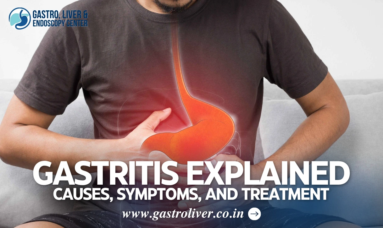 Gastritis Explained: Causes, Symptoms, and Treatment
