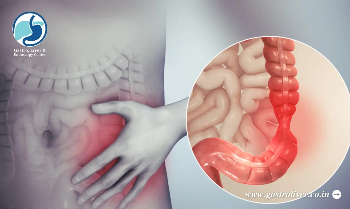 Understanding Irritable Bowel Syndrome