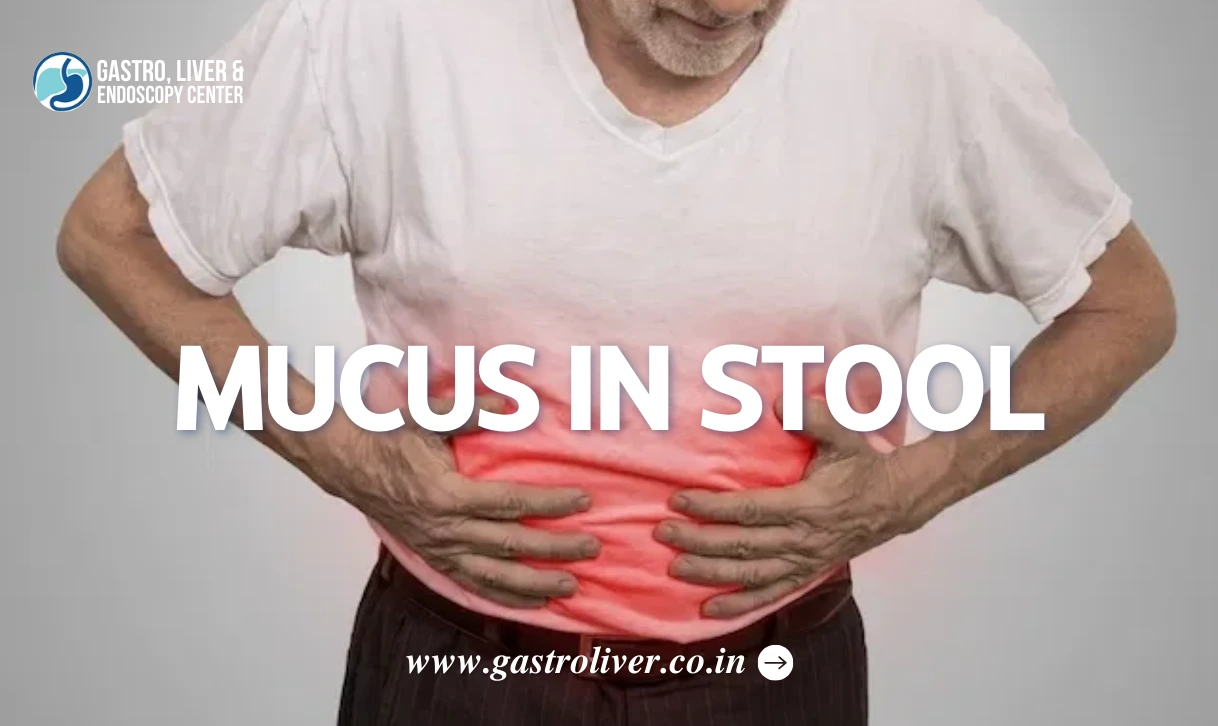 Mucus in Stool: Causes, Diagnosis, Treatment, and Home Remedies