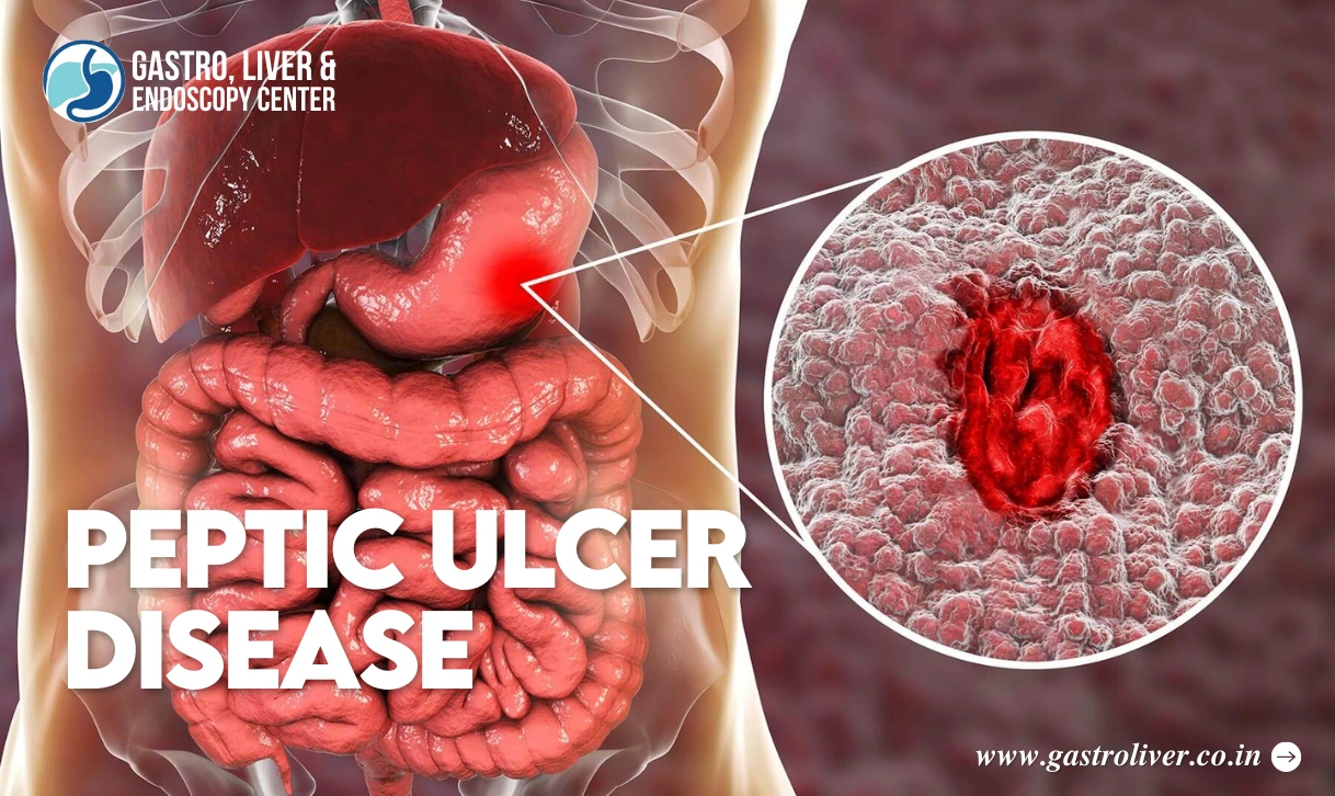 Peptic Ulcer Disease: Causes, Treatment, and How to Prevent It