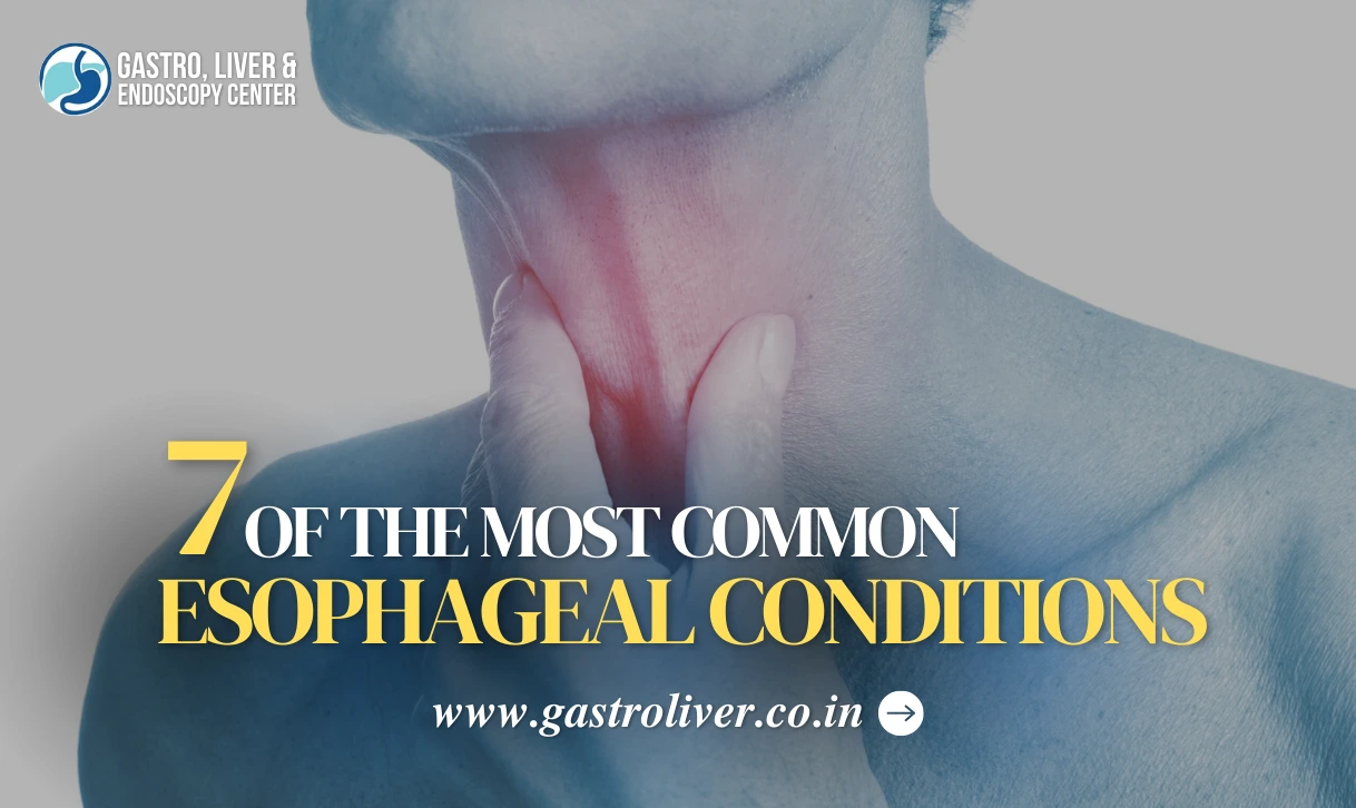 7 of the Most Common Esophageal Conditions