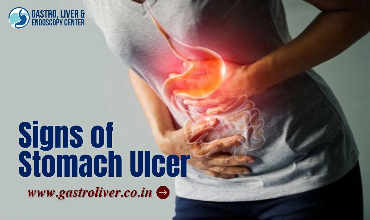 Signs of Stomach Ulcer