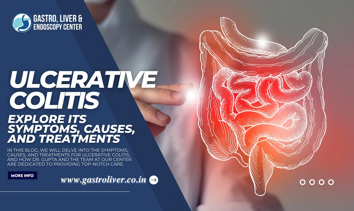 Ulcerative Colitis: Explore Its Symptoms, Causes, and Treatments