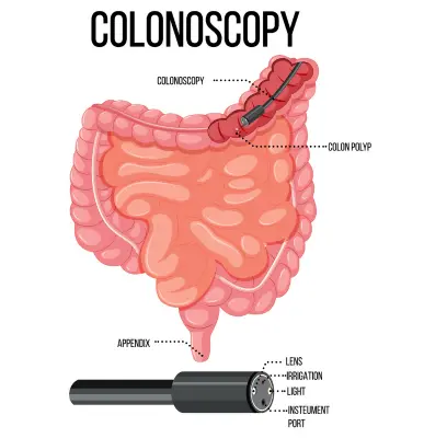 Colonoscopy - Top/Best Gastroenterologist in Indirapuram Ghaziabad, Noida Extension