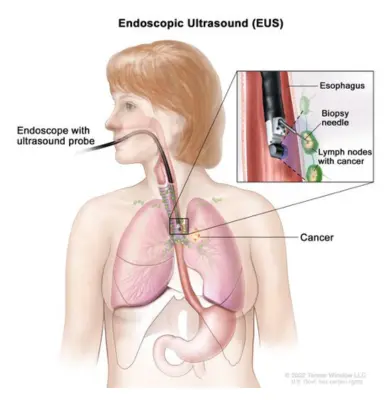 Endoscopic Ultrasonography - Top Gastroenterologist in Noida