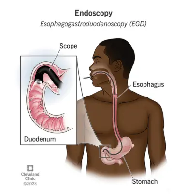 Endoscopy - Fibroscan Liver Test Near Me