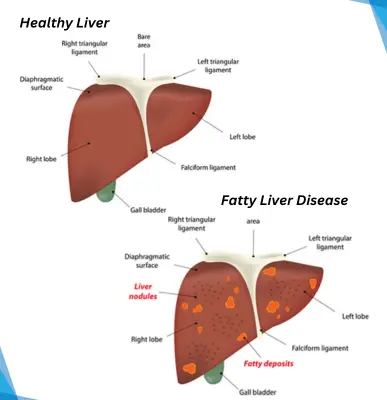 Fatty Liver - Top 3 Gastroenterologist in Noida