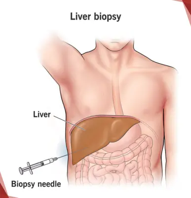 Liver Biopsy - Best Gastroenterologist Near Me