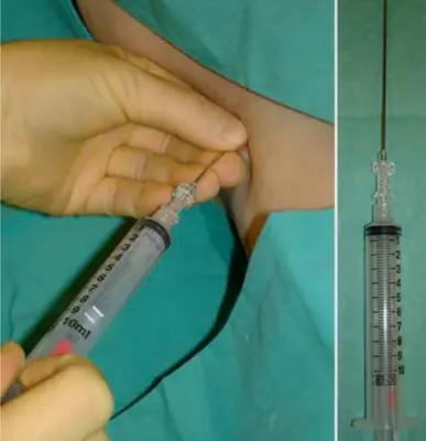 Liver Biopsy - Best Gastro Liver & Endoscopy Center in Ghaziabad